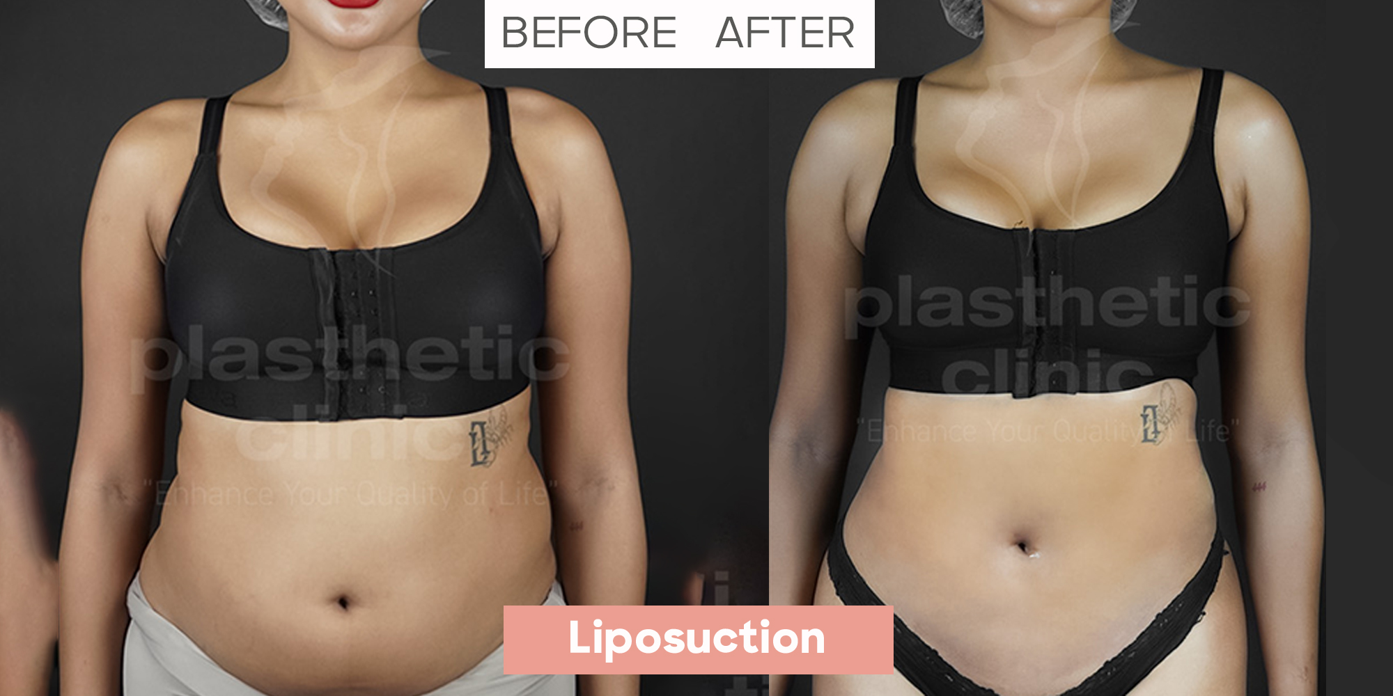 Liposuction Front View