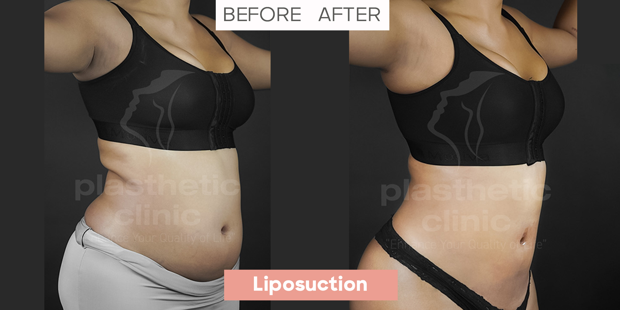 Liposuction 45° View