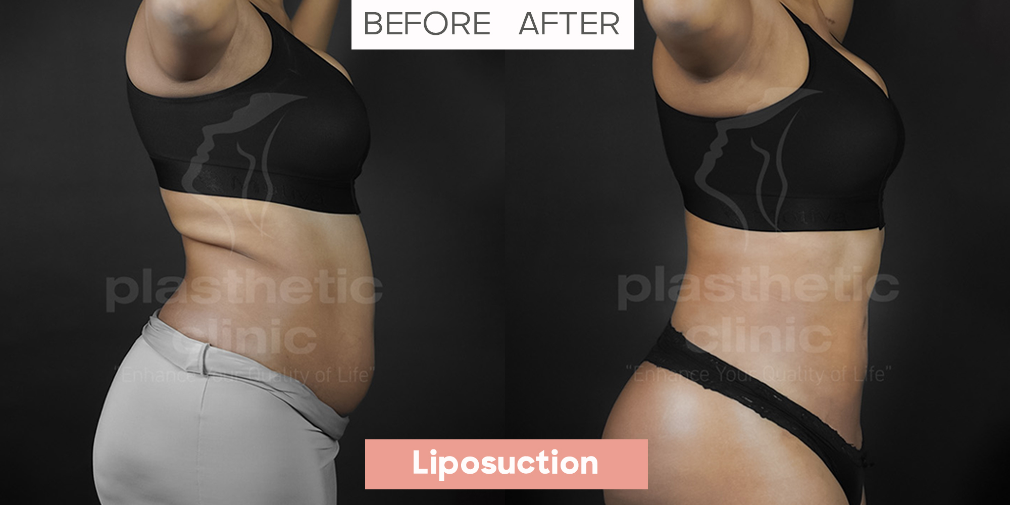 Liposuction Profile View