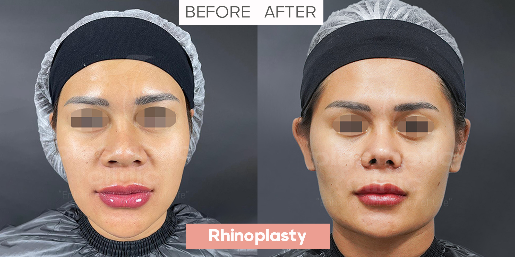 Rhinoplasty Front View