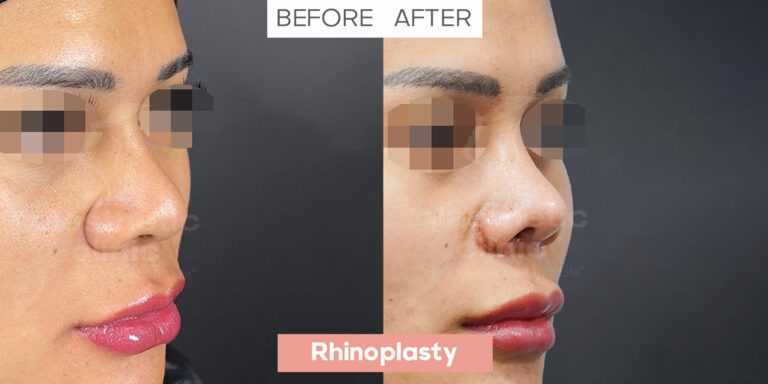 Rhinoplasty