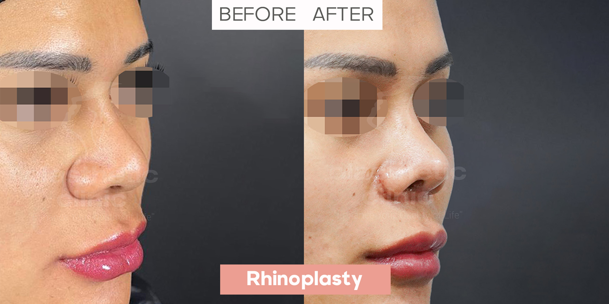 Rhinoplasty 45° View