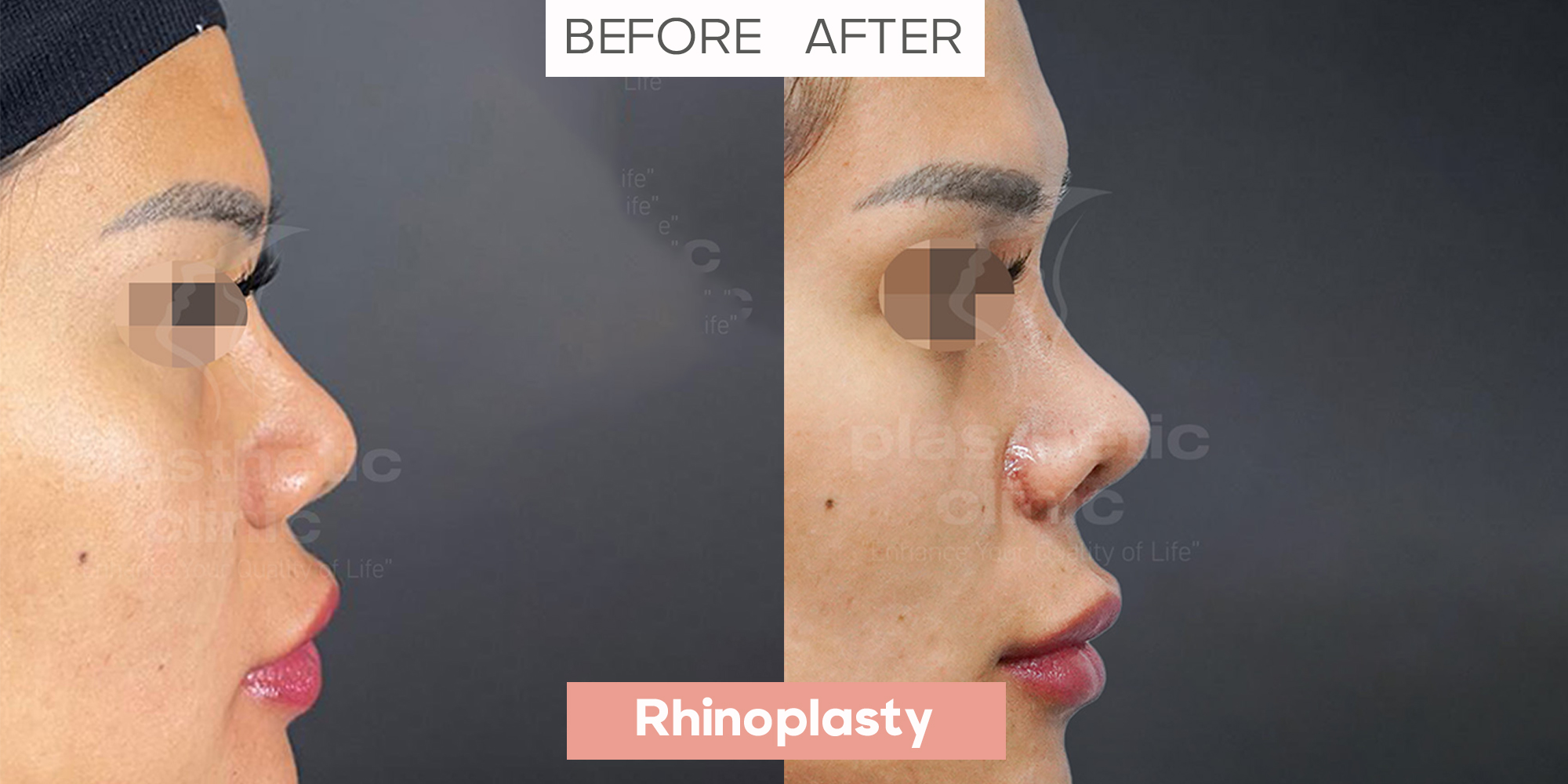Rhinoplasty Profile View