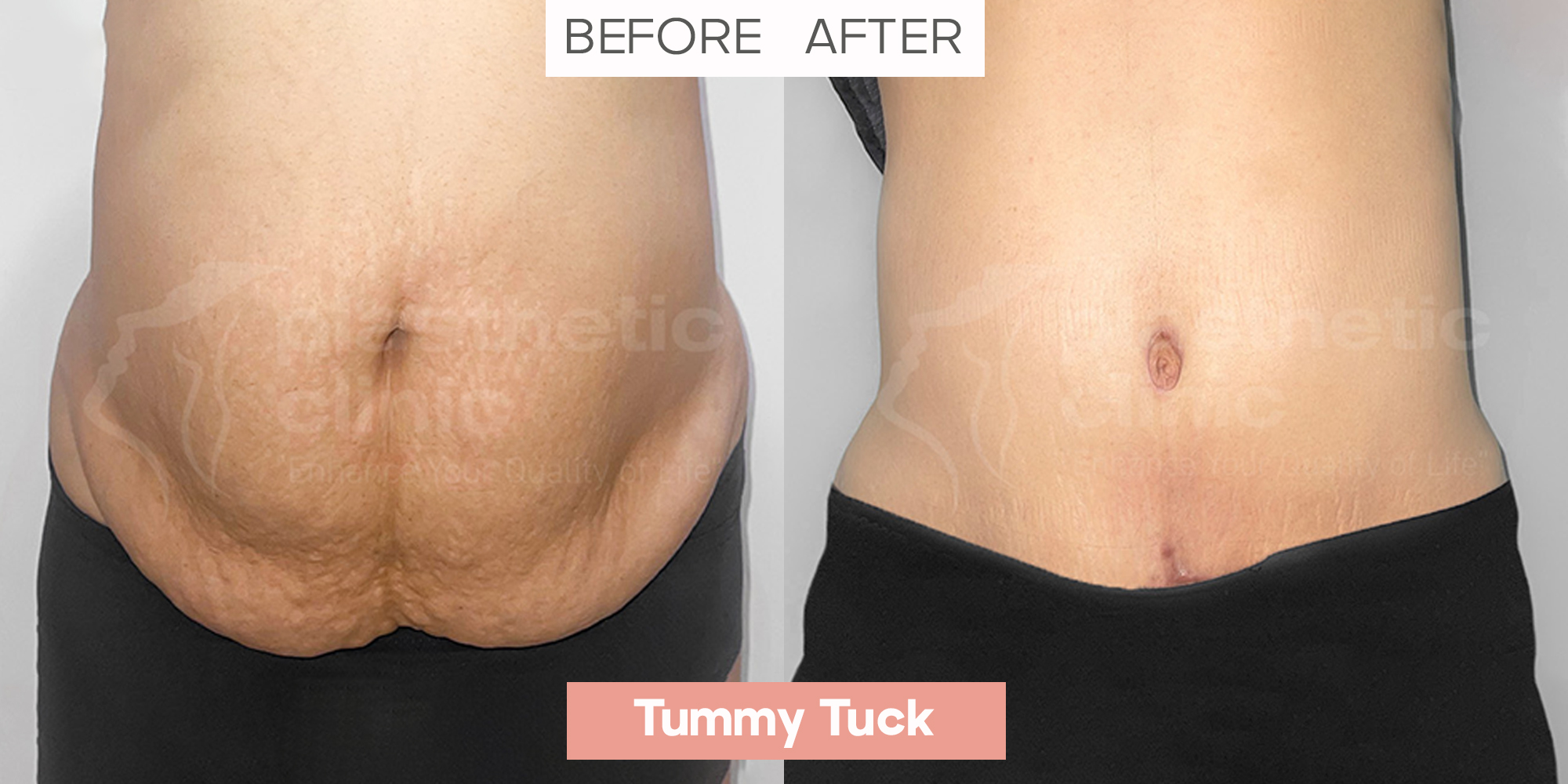 Tummy Tuck Front View