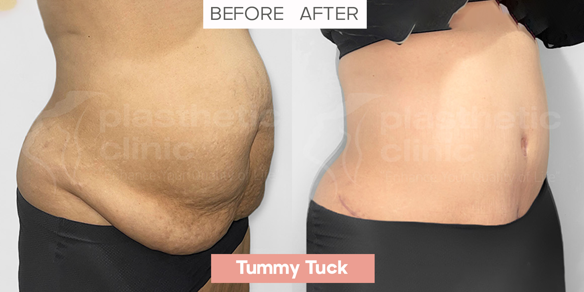Tummy Tuck 45° View