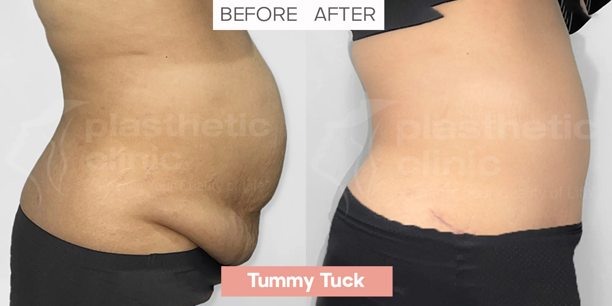 Tummy Tuck Profile View